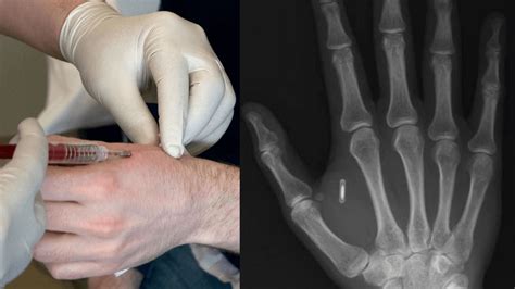 the new rfid chip|rfid implants in the hand.